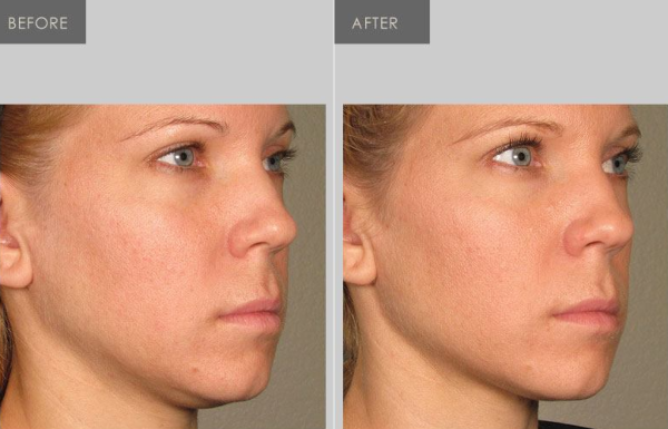 Ultherapy tighten jawline