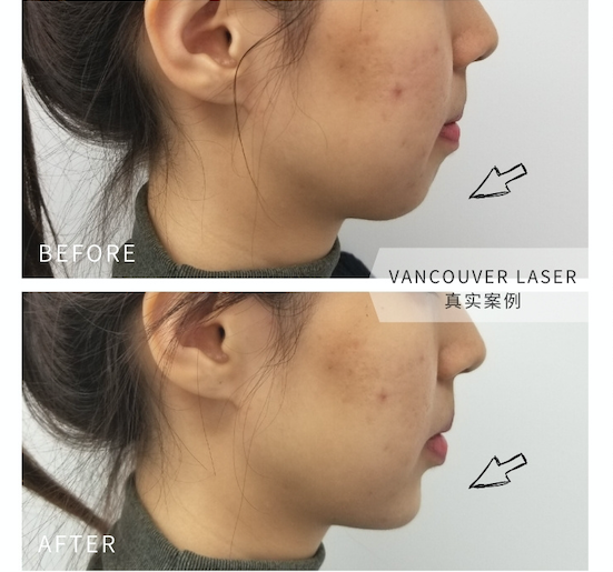 Vancouver Laser玻尿酸填充下巴前后对比